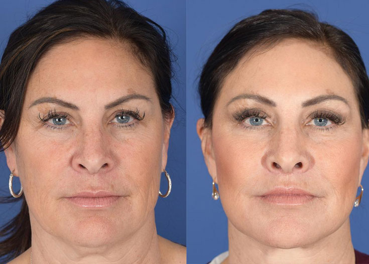 Kaş Kaldırma (Brow Lifting)